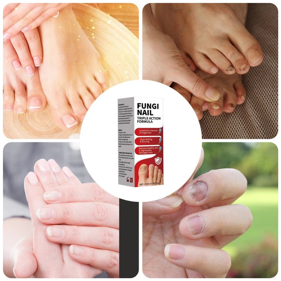 Fungi Nail Anti-Fungal Liquid Herbal Extracts Toenail Fungus Treatment Safe Us Serenzza